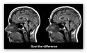 Nessuna differenza fra cervello autistico e quello di soggetti normodotati